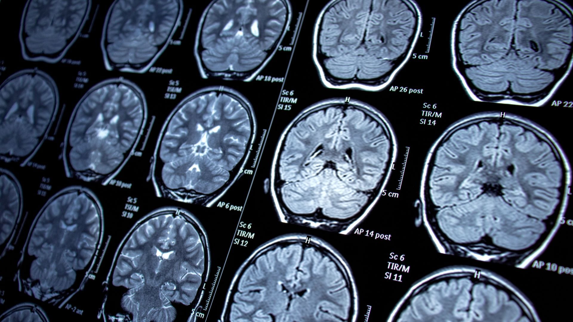Bild på magnetresonanstomografi vid epilepsi